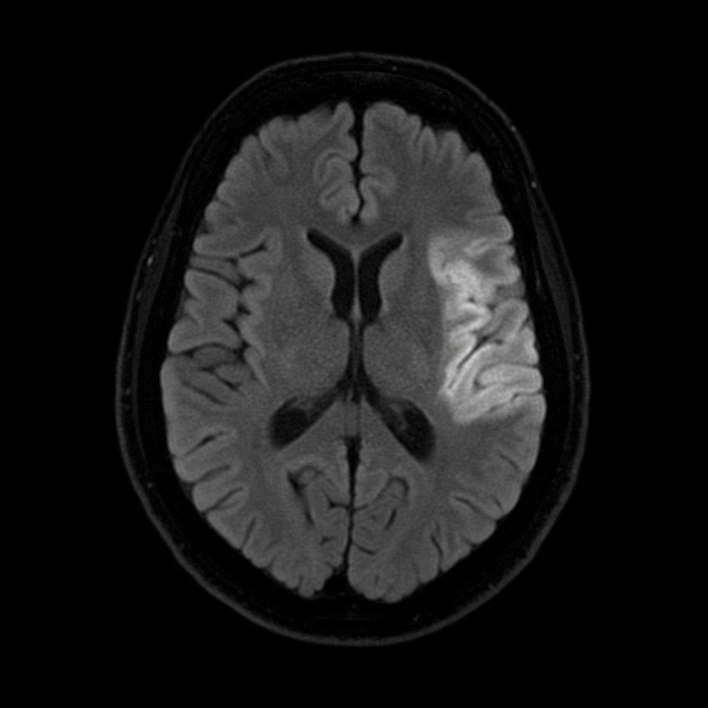 Axial brain MRI — FLAIR sequence
