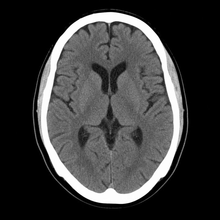 Axial non-contrast CT of the brain — normal study